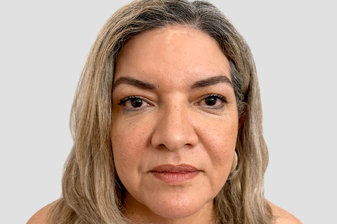 After-SCULPTRA