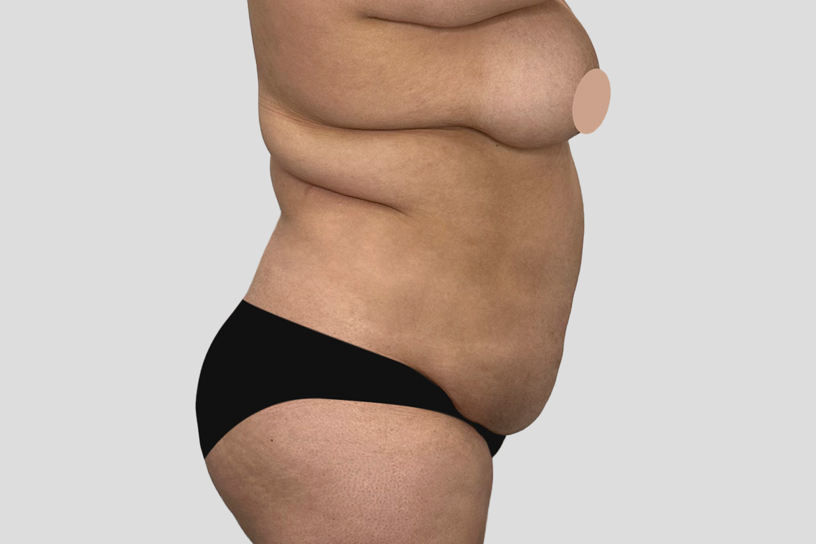 Before-ABDOMINOPLASTIA