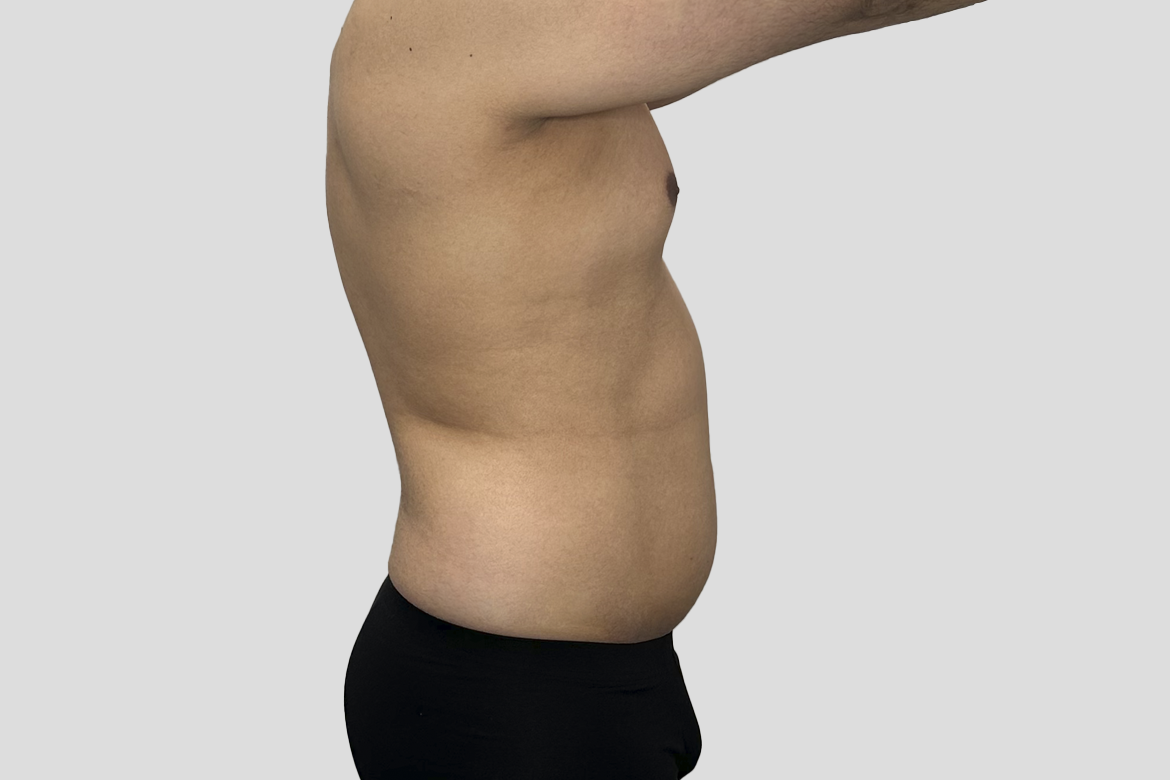Before-GINECOMASTECTOMÍA + LIPOSUCCIÓN DE ABDOMEN Y ESPALDA BAJA
