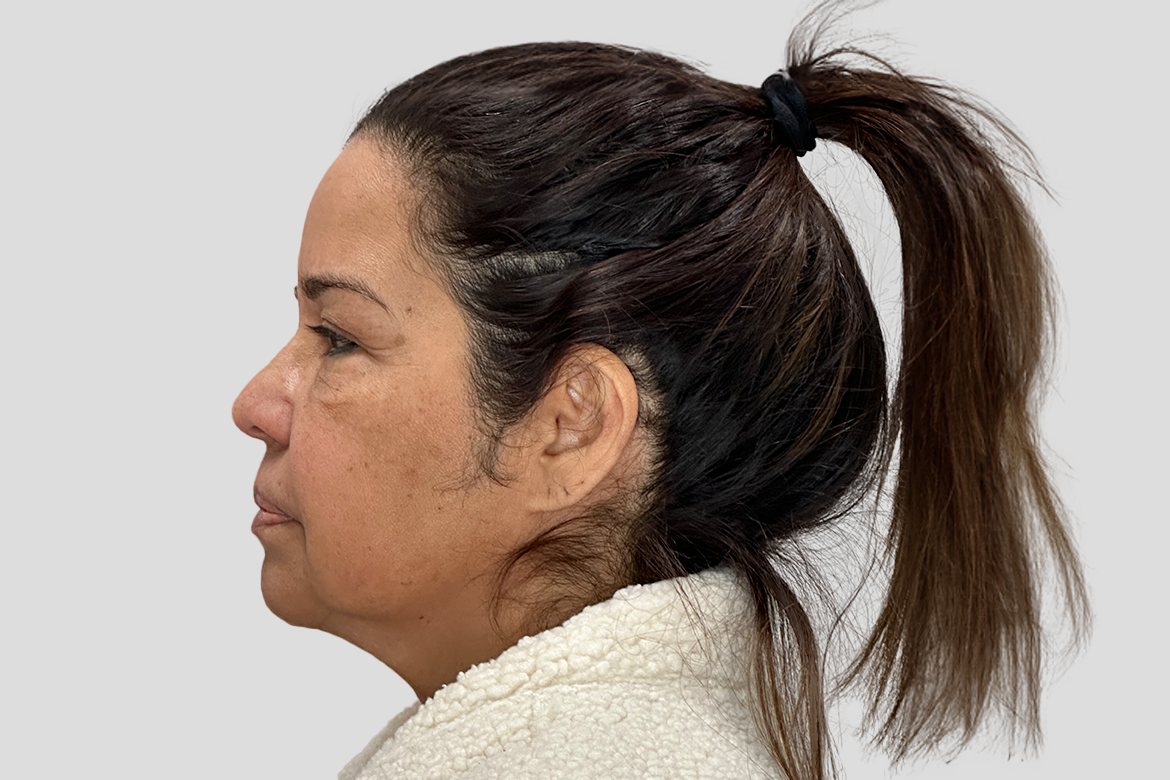 Before-BLEFAROPLASTIA SUPERIOR E INFERIOR